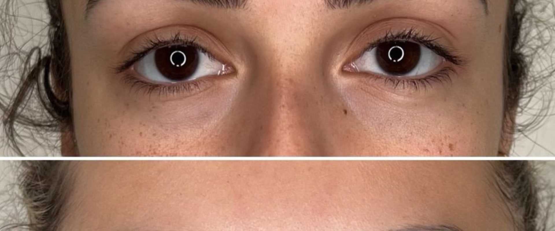 How Your Job Affects Your Brow Line: Occupational Stress and Facial Ageing