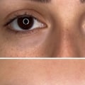 How Your Job Affects Your Brow Line: Occupational Stress and Facial Ageing